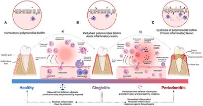 Periodontal Inflammation and Systemic Diseases: An Overview